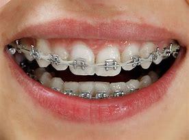 Best Quality Dental Braces