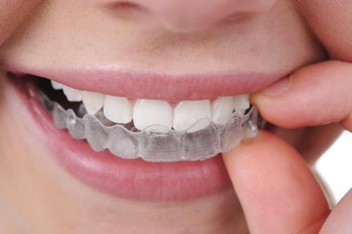 Invisible Aligners For Teeth