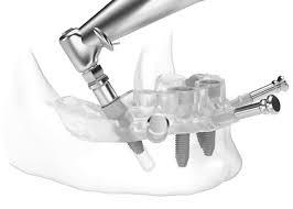 Surgical Guide for Dental Implant