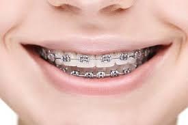 Quality Tested Dental Braces