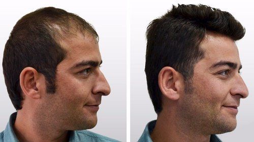 Hair Transplant Services