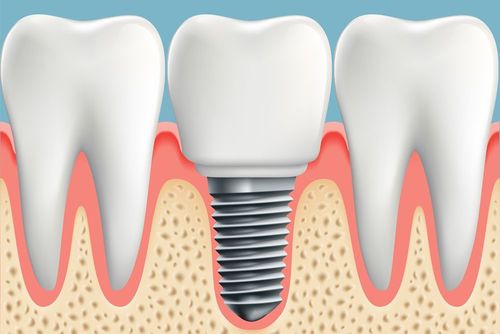 Single Tooth Replacement Service