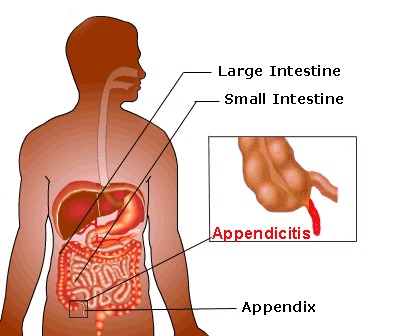 Appendicitis Treatment Services
