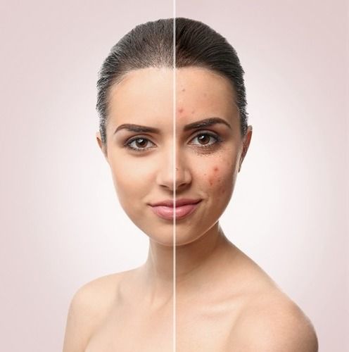 Chemical Skin Peels Services