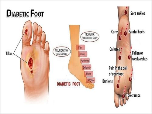 All Diabetic Foot Care Treatment Service