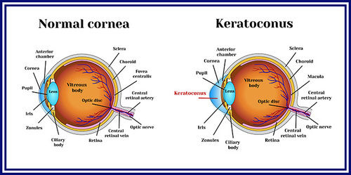 Keratoconus Treatment Services