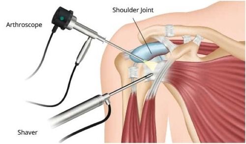 Shoulder Arthroscopy Treatment Services