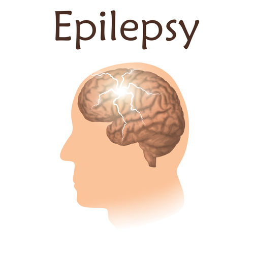 Epilepsy Treatment Services By Dr.Vanchilingam Hospital