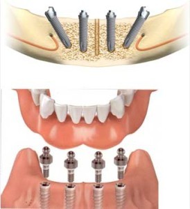 Dental Implant Treatment Services By Smile Architect