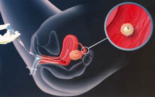 Intrauterine Insemination Treatment Services