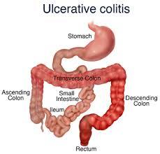 Ulcerative Colitis Treatment Services By SIMS Hospital