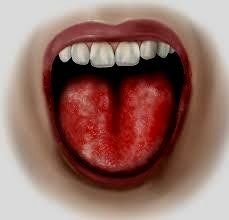 Herbal Remedies for Burning Mouth