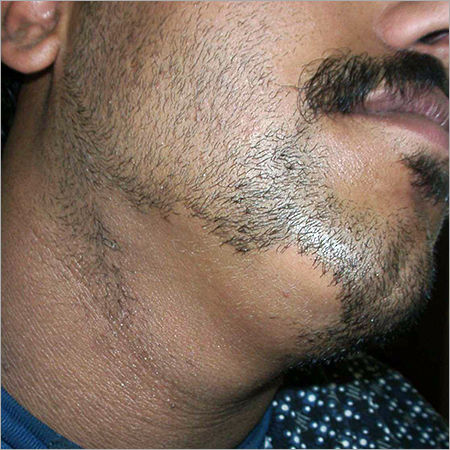 Alopecia Areata Homeopathy Treatment By AASHIRWAD HOMEOPATHIC CLINIC