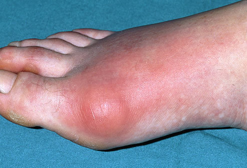 HOMEOPATHIC RHEUMATOID GOUT TREATMENT