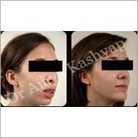 Non-surgical Chin Augmentation