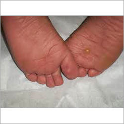 Foot Corn Homeopathic Treatment