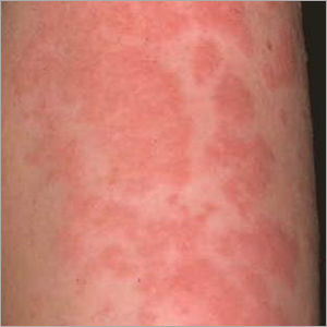 Homeopathic Urticaria Treatment