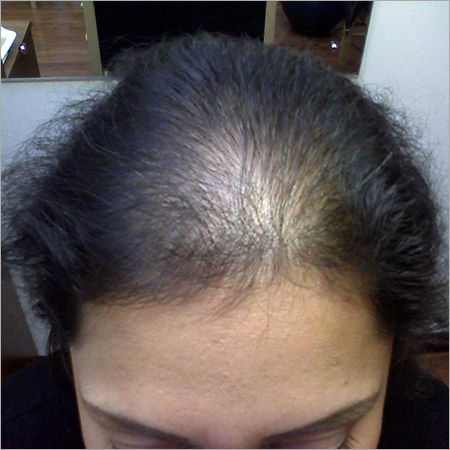 Female Hair Loss Treatment in Phoenix AZ 85054  Focal Point Vitality