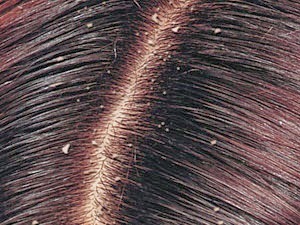 Homeopathic Dandruff Treatment