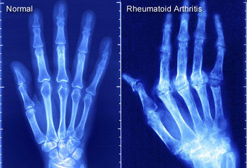 Homeopathic Rheumatoid Arthritis Treatment