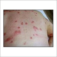 Bed Bugs Health Risks