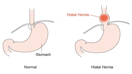 Hiatal Hernia Treatment Services