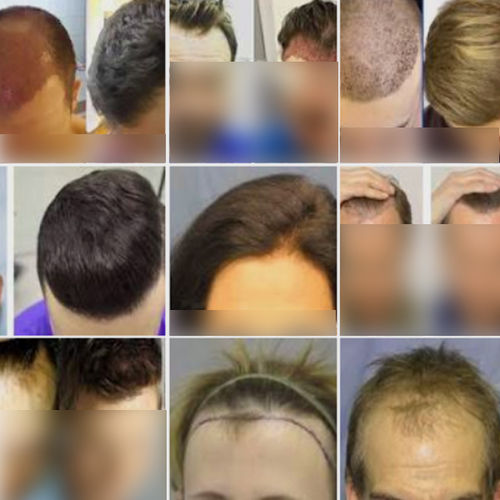 Hair Transplantation Services