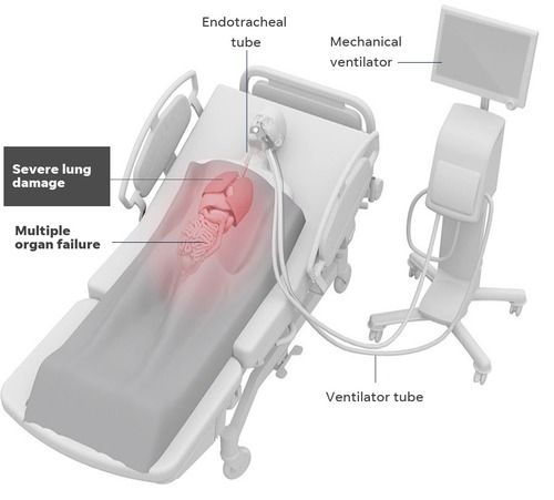 Lung Ventilator