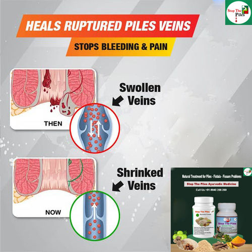 Piles Ayurvedic Treatment Medicine