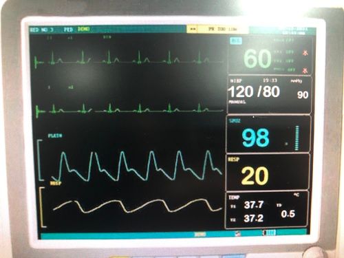 High Speed Hospital 220-450 Volt Cardiac Monitor Application: For Heart Patients