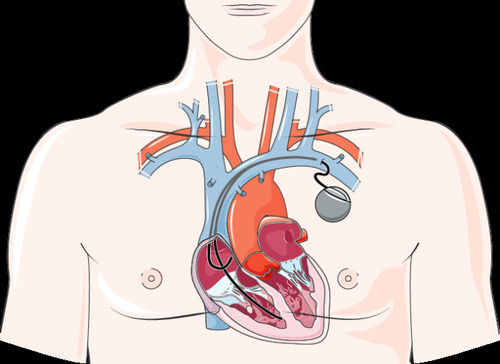 Multicolour Pacemaker (Artificial Heart) For Hospital Use