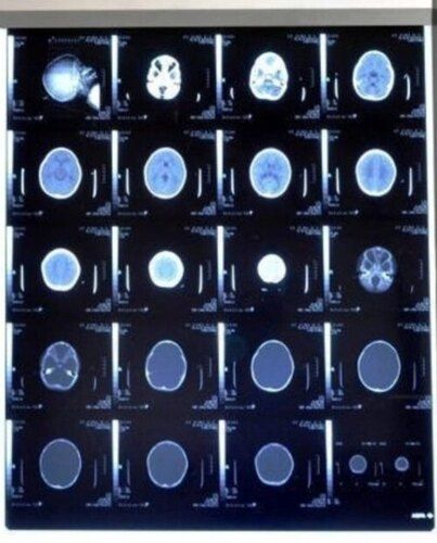 Single Screen X-ray View Box For Hospital, No Uv Emission