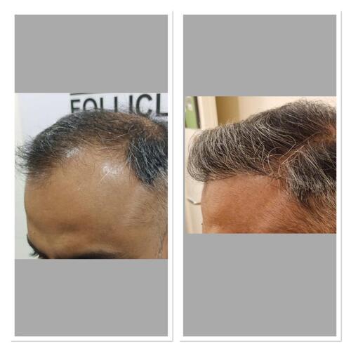 Neo Follicle Transplant