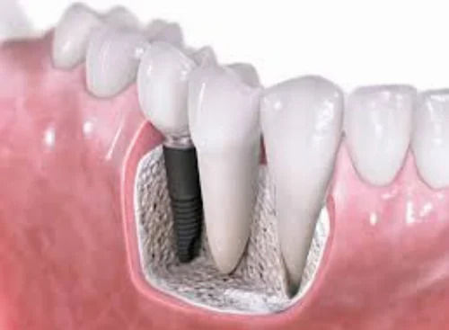 Dental Implants Treatment Service