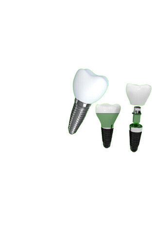 Dental Implants