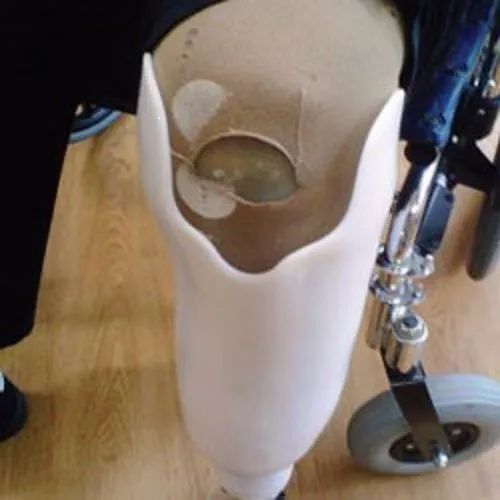 RCR Transtibial Socket - Skin Friendly, Strong & Durable | Easy To Operate, Unbelievably Reliable, Flame Proof, Sterilized, Easy To Wear