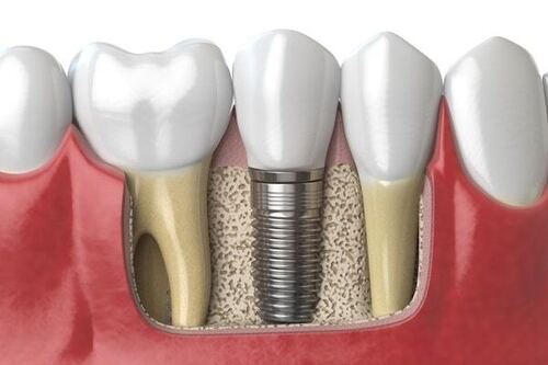 Tooth Implants