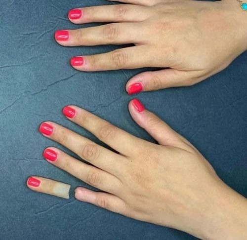 Silicone Partial Hand Prosthesis