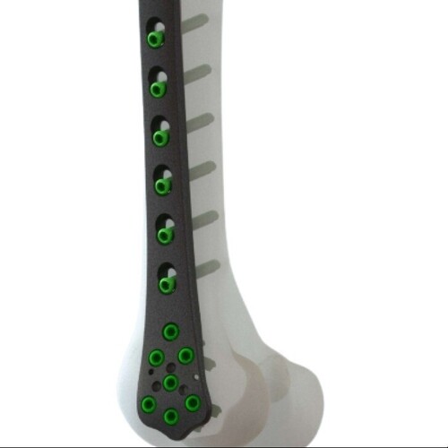 Distal Femur Locking Plate