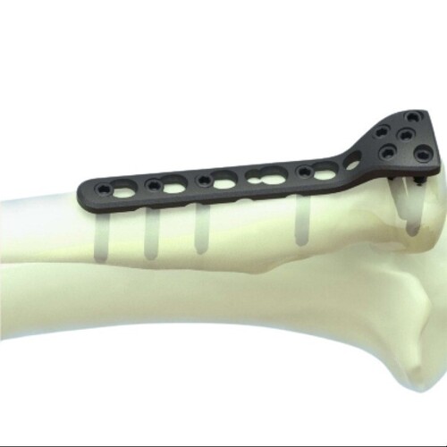 Proximal Lateral Tibia Locking Plate - Application: Medical