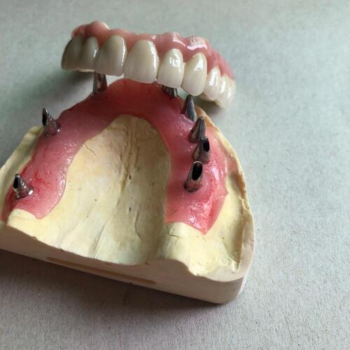 Screw-Retained Dentures