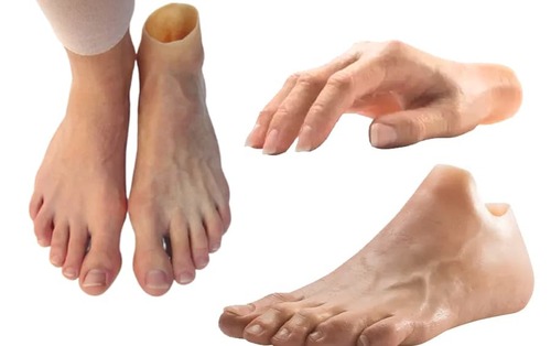 Silicone Prosthesis - Accuracy: Na