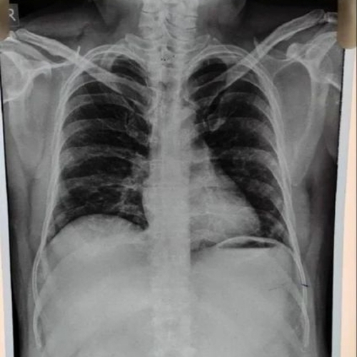 Blue Inkjet X Ray Film