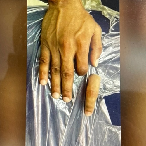 Artificial Ring Finger