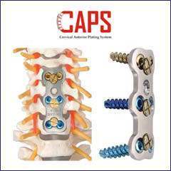 Cervical Anterior Plating System