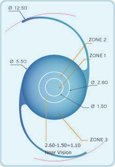 PMMA Multifocal Lens