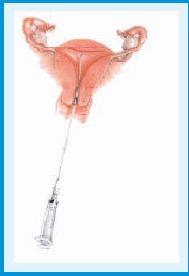 IUI Catheter