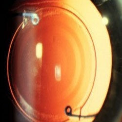 Multifocal Intraocular Lens