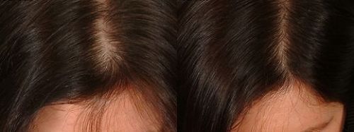 Hair Fixing cost in India  Permanent Hair Fixing  Good Hair Fixing in  Delhi
