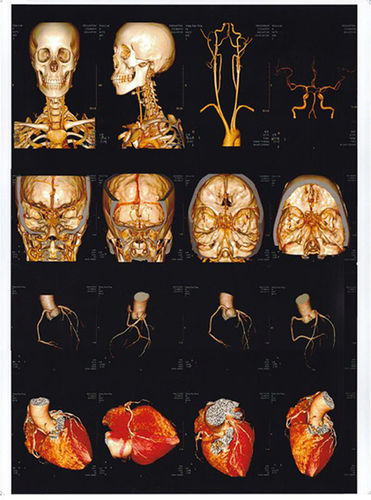 Inkjet Medical Used Dry X-Ray Medical Film